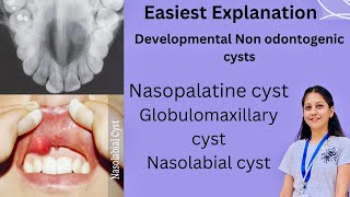 Developmental Non Odontogenic cysts Oral Pathology BDS Nasopalatine Globulomaxillary Nasolabial [upl. by Ailido232]