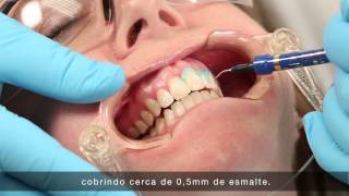 Uveneer® Procedure Animation  Direct Veneer Template System [upl. by Alegnaed]