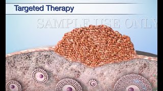 Treatment Options for Ovarian Cancer [upl. by Gnet]