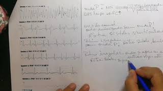 ECG padroes de ritmos [upl. by Nonnelg]