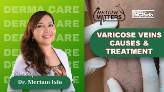 Varicose Veins Causes amp Treatment  Health Matters  September 23 2024 [upl. by Atiuqan]