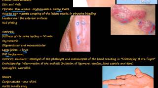 99P Psoriatic Arthritis quotpencil in cupquot deformity [upl. by Yenahteb]