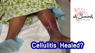 Cellulitis Infection Before After Video [upl. by Eskill]