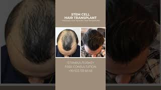 STEM CELL HAIR TRANSPLANT Painless Fast Healing Hair Transplant [upl. by Ailedamla]