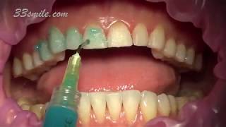 Prepless Veneers Permanent Teeth Whitening [upl. by Asiram23]