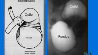 Gastric Volvulus in a Newborn [upl. by Eeladnerb]