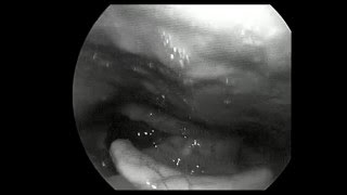 Video laryngoscopy showing Intra Epithelial Cell Carcinoma of Larynx [upl. by Eseilanna]