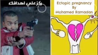 13 ectopic pregnancy by dr M Ramadan [upl. by Tnattirb944]