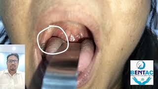 information about tonsillolith and tonsil stone removal in hindi [upl. by Morez]