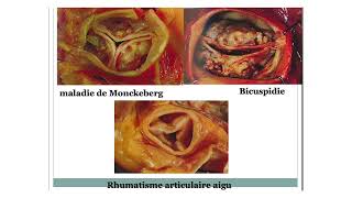 rétrécissement aortique [upl. by Ahtabat787]