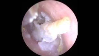 Endoscopic Ear Suction of Discharge and Keratin  Mr Neel Raithatha The Hear Clinic  Leicester [upl. by Garin]