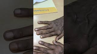 Swan Neck Deformity in Rheumatoid Arthritis। Ulnar deviation of fingers। Nodules on knuckles [upl. by Zebadiah194]