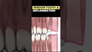 Why wisdom tooth gums inflamed [upl. by Marena]