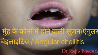 408 मुंह के कोनों में होने वाली सूजनएंगुलर चेइलाइटिस Angular cheilitis और EH चिकित्सा [upl. by Felten802]