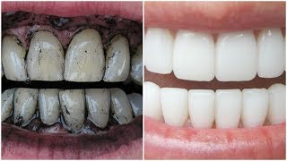 Whiten Teeth with Charcoal  1000 Working  Whiten Teeth at Home FAST [upl. by Anitahs8]