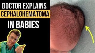 Doctor explains Cephalohematoma in babies  including causes pictures treatment and more [upl. by Odysseus]