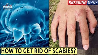 Scabies outbreak UK  Symptoms and how to get rid of [upl. by Manning]