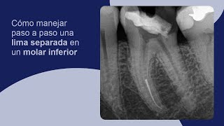 Cómo manejar paso a paso una lima separada en un molar inferior [upl. by Nahseez]