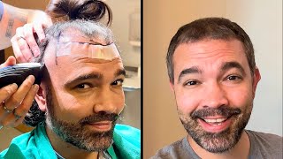 Cajun Ninja FUE Hair Transplant Day 1 to 3 Months [upl. by Eimarej162]