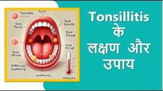 Signs of Tonsillitis  Early Symptoms amp When to See a Doctor [upl. by Towbin]