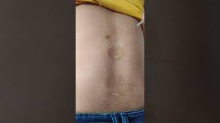 Dry acupuncture needles for back pain treatment [upl. by Eelik]