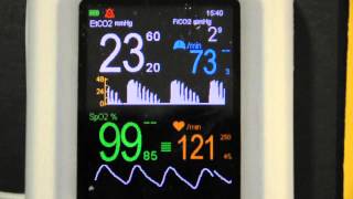 Cardiogenic Oscillations on VM2500M capnograph pulse oximeter [upl. by Ailaza]