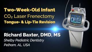 Infant CO2 Laser Frenectomy  Tongue amp LipTie Release  Richard Baxter DMD [upl. by Eterg]