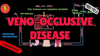 VENOOCCLUSIVE DISEASE Hemodynamics Mechanism of clinical symptoms [upl. by Burl]