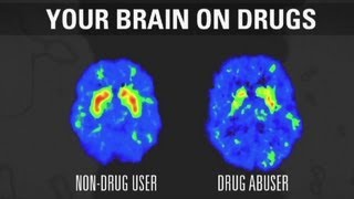 How addiction changes your brain [upl. by Nirek264]