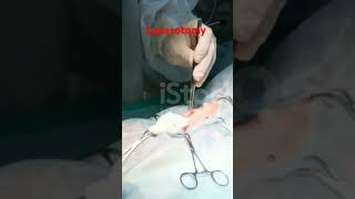 Abdominal incision  laparotomy  medical knowledge  viral short  trend video  views [upl. by Nilsoj]