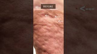 JawDropping Fascia Blaster Cellulite Before amp After [upl. by Yelsgnik]