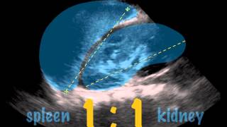 SonoKids Tutorials  ScanTip  SPLENOMEGALY [upl. by Harman276]