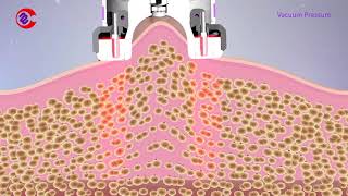 How Vacuum RF Fat Reduction Skin Tightening Treatment WorkSlimming Lymphatic Drainage Machine [upl. by Xavler]