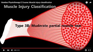 Hawkes Physiotherapy E Course Muscle injury classification [upl. by Ravert]