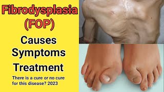 FOP Fibrodysplasia ossification progressiva causes symptoms and treatment  Fop treatment 2023 [upl. by Adnamar345]