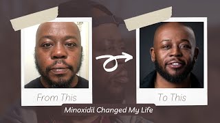 I Tried Minoxidil For 3 Years My Transformation Experience [upl. by Athalla747]