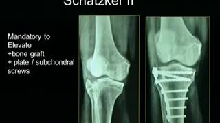 Tibial Plateau Fractures [upl. by Delwin]