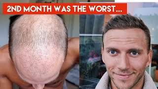 My Hair Transplant Journey  The AWFUL first 4 months indepth walkthrough week by week [upl. by Cally]