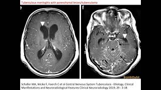 31 Neurosarcoidosis and tuberculous meningitis leptomeningeal perivascular granulomatous [upl. by Htiekel]