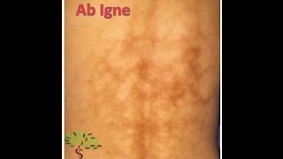 Erythema Ab Igne [upl. by Llehcal]