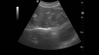 Schistosomiasis liver 주혈흡충증 간 [upl. by Ecirtak896]