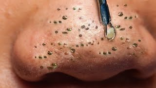 Blackhead Removal With Sac Dep Spa 1000373 [upl. by Nylatsirhc]