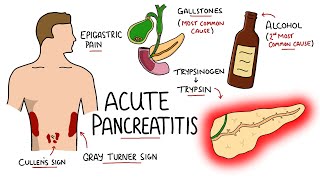 Acute Pancreatitis  Causes Signs amp Symptoms Pathophysiology Diagnosis [upl. by Bryant413]