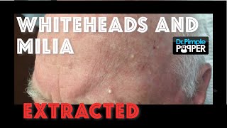 Whiteheads and milia extracted after Mohs surgery [upl. by Ahsenot]