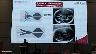 Video 2 Corpus Callosum Diagnosis [upl. by Saunders]