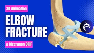 Elbow Olecranon Fracture and Fixation  3D Animation [upl. by Harman9]