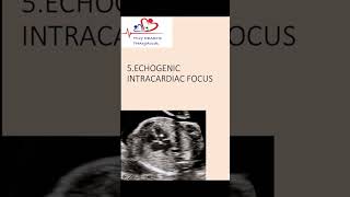 Echogenic intracardiac focus on antenatal scanwhat does it mean echogenicfocus heart [upl. by Legnalos]