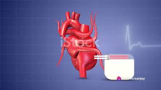 Pacemakers The Hearts Rhythm Keeper [upl. by Ruckman]