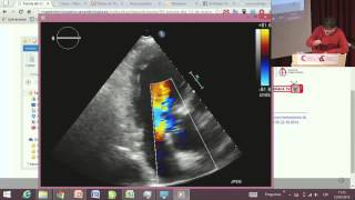 Máster Técnico en Ecocardiografía Tutoría 3 [upl. by Thilde410]