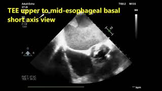 A transesophageal echocardiography TEE quiz [upl. by Elacim356]